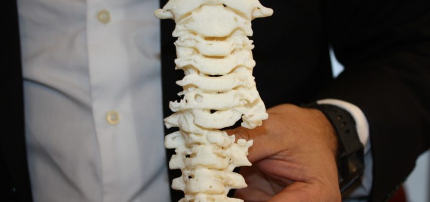 Niña de 5 años recibe modelo de columna cervical a escala impresa en 3D